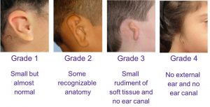The different grades of Microtia that can occur in children